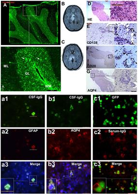 Overlapping Autoimmune Syndromes in Patients With Glial Fibrillary Acidic Protein Antibodies